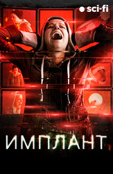 Имплант